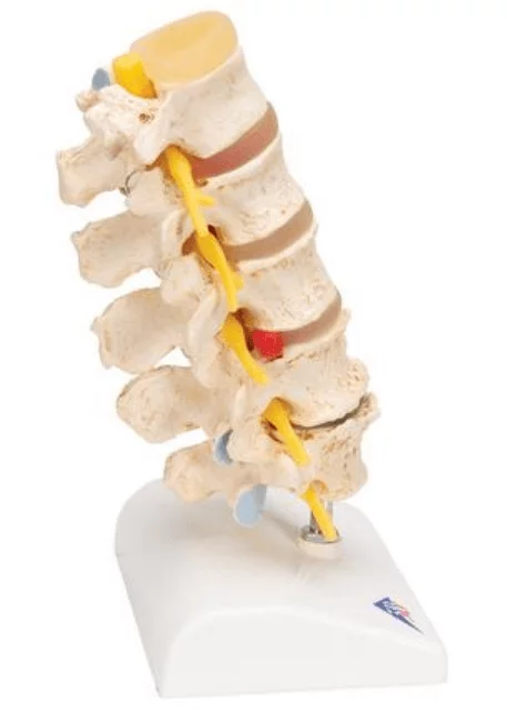  Anatomisch model van Hernia