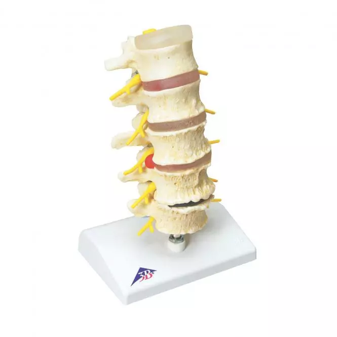  Anatomisch model van Hernia