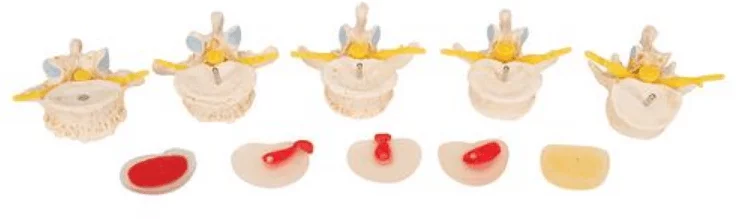 Anatomisch model van Hernia