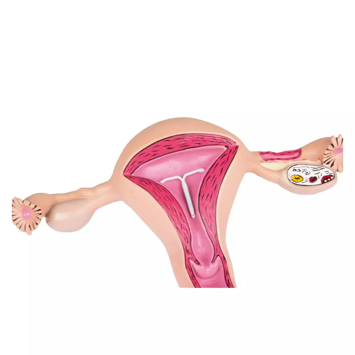 Baarmoedermodel  Baarmoedermodel