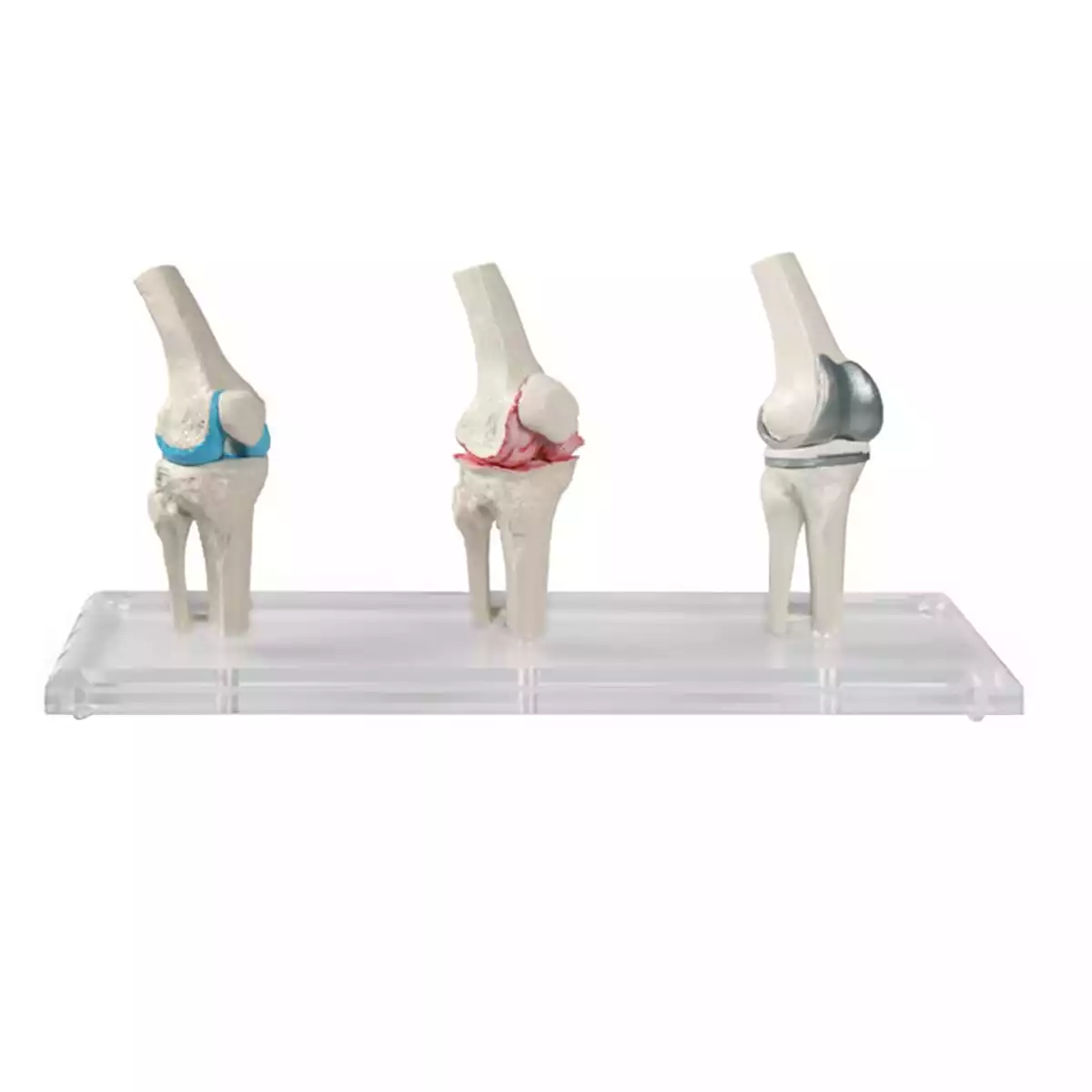  Model voor knie-implantaten