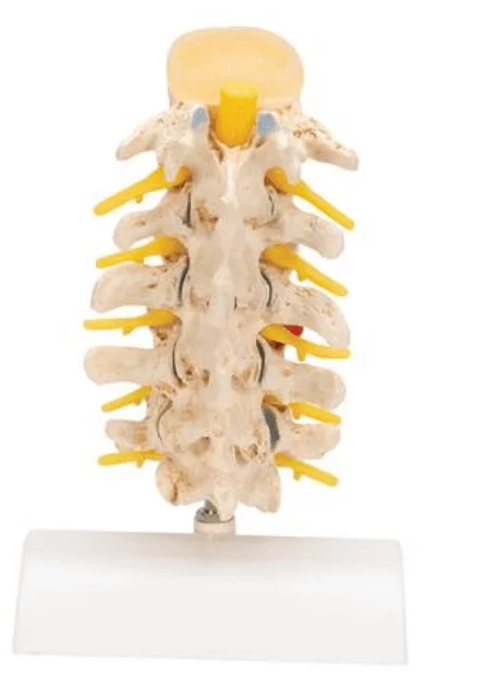  Anatomisch model van Hernia